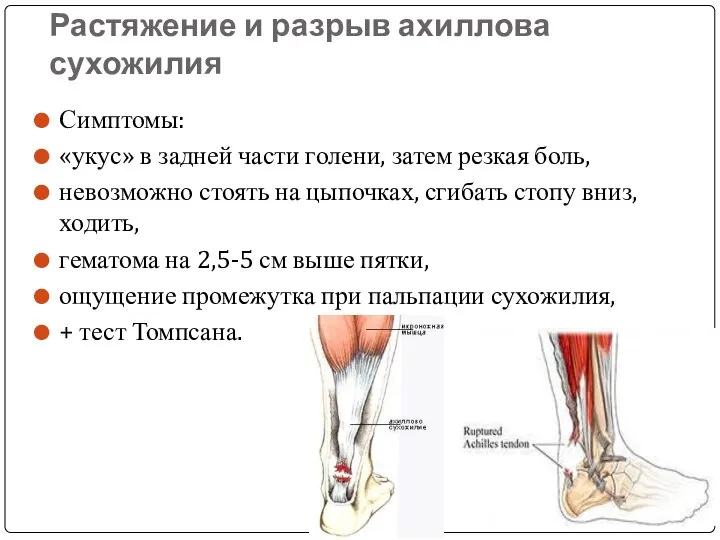 Растяжение и разрыв ахиллова сухожилия Симптомы: «укус» в задней части голени,