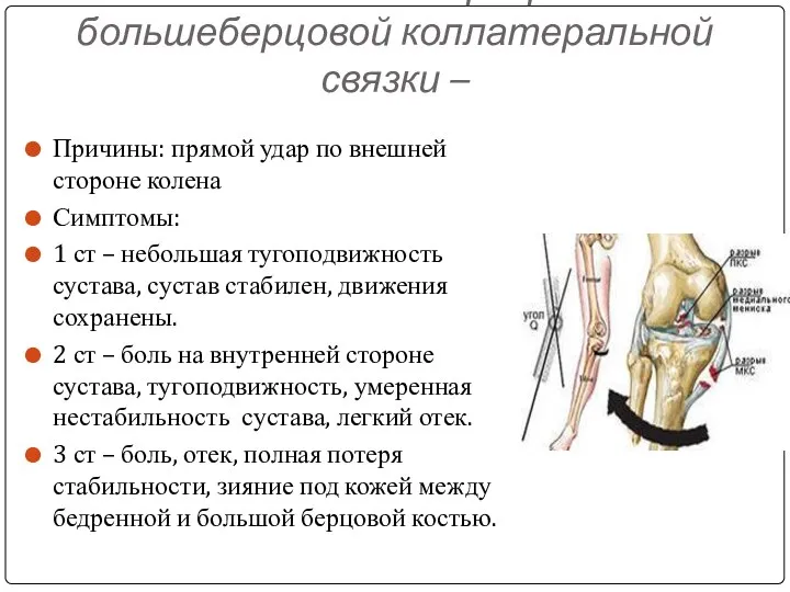 Растяжение и разрыв большеберцовой коллатеральной связки – Причины: прямой удар по