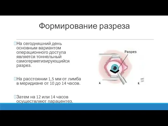 Формирование разреза На сегодняшний день основным вариантом операционного доступа является тоннельный