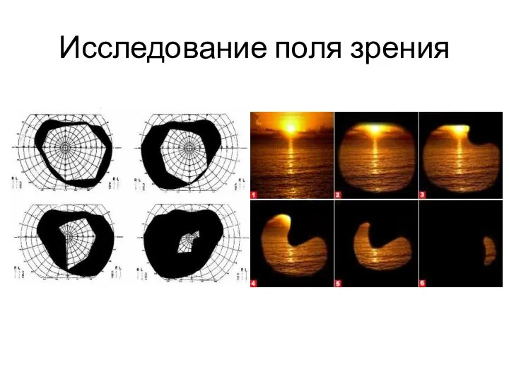 Исследование поля зрения