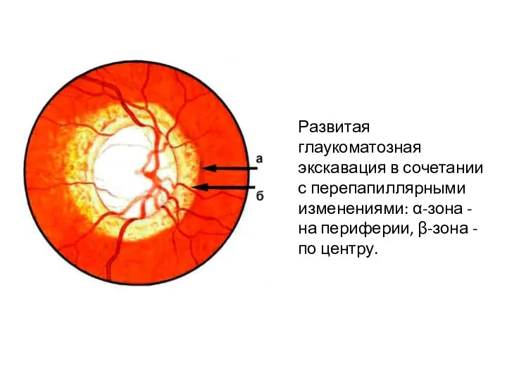 Развитая глаукоматозная экскавация в сочетании с перепапиллярными изменениями: α-зона - на периферии, β-зона - по центру.
