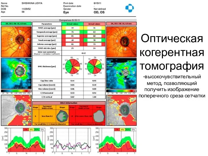 Оптическая когерентная томография -высокочувствительный метод, позволяющий получить изображение поперечного среза сетчатки