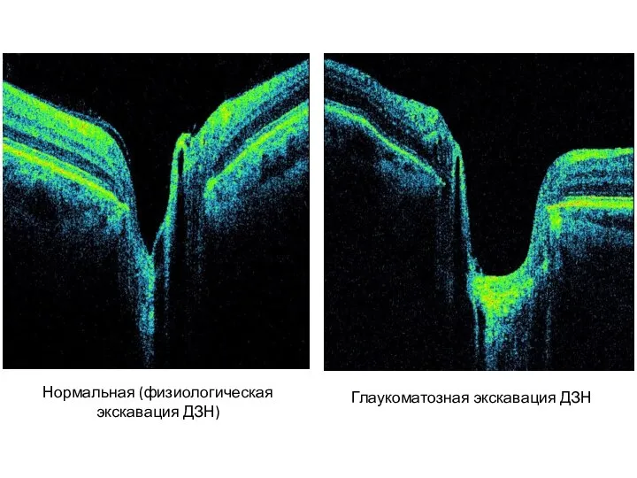 Нормальная (физиологическая экскавация ДЗН) Глаукоматозная экскавация ДЗН