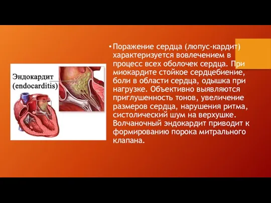 Поражение сердца (люпус-кардит) характеризуется вовлечением в процесс всех оболочек сердца. При