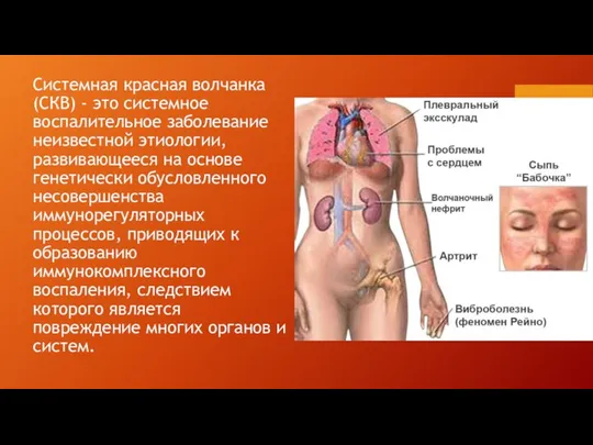 Системная красная волчанка (СКВ) - это системное воспалительное заболевание неизвестной этиологии,