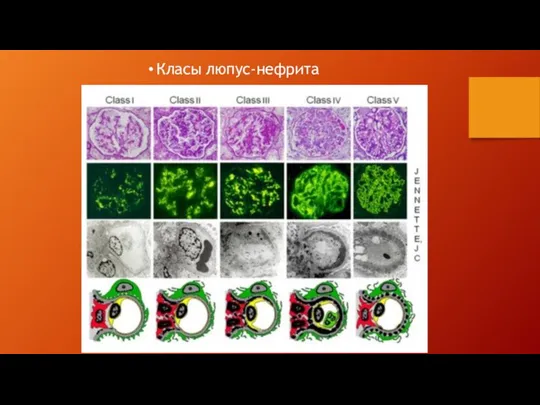 Класы люпус-нефрита