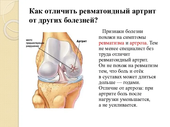 Как отличить ревматоидный артрит от других болезней? Признаки болезни похожи на