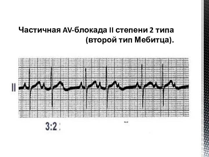 Частичная AV-блокада II степени 2 типа (второй тип Мебитца).