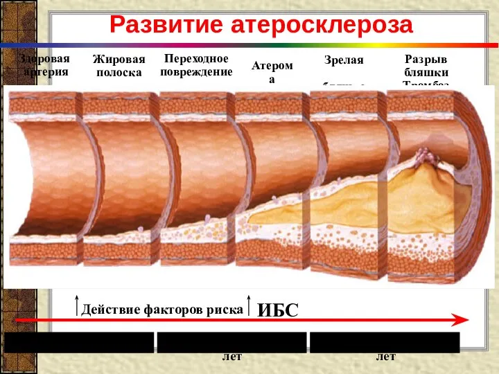 Развитие атеросклероза Здоровая артерия Жировая полоска Переходное повреждение Атерома Зрелая бляшка