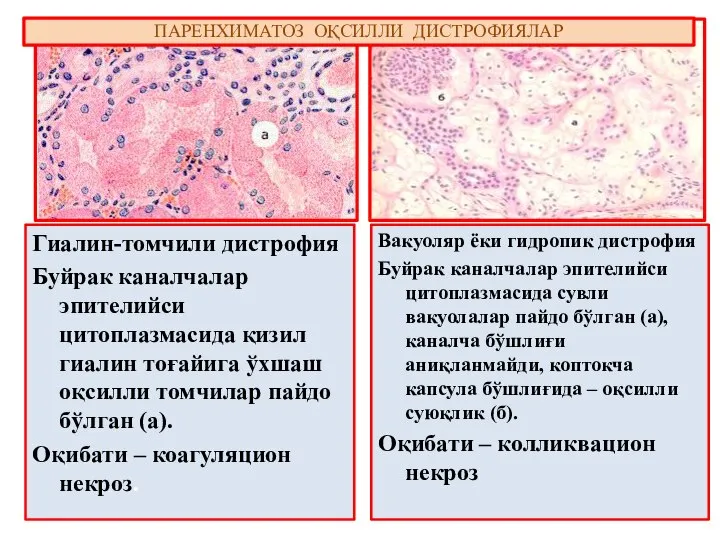 Гиалин-томчили дистрофия Буйрак каналчалар эпителийси цитоплазмасида қизил гиалин тоғайига ўхшаш оқсилли