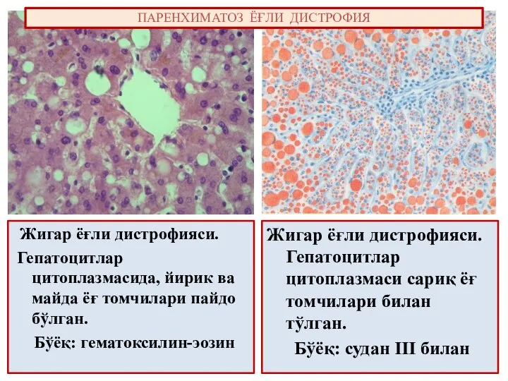 Жигар ёғли дистрофияси. Гепатоцитлар цитоплазмасида, йирик ва майда ёғ томчилари пайдо