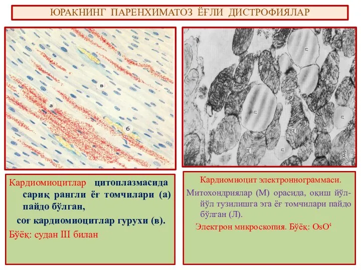 ЮРАКНИНГ ПАРЕНХИМАТОЗ ЁҒЛИ ДИСТРОФИЯЛАР Кардиомиоцитлар цитоплазмасида сариқ рангли ёғ томчилари (а)