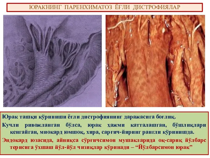 ЮРАКНИНГ ПАРЕНХИМАТОЗ ЁҒЛИ ДИСТРОФИЯЛАР Юрак ташқи кўриниши ёғли дистрофиянинг даражасига боғлиқ.