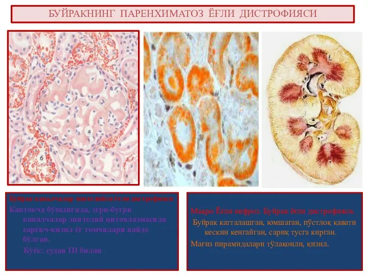 БУЙРАКНИНГ ПАРЕНХИМАТОЗ ЁҒЛИ ДИСТРОФИЯСИ Буйрак каналчалар эпителийси ёғли дистрофияси Каптокча бўшлиғида,