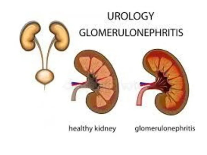 Glomerulonefrit