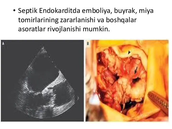 Septik Endokarditda emboliya, buyrak, miya tomirlarining zararlanishi va boshqalar asoratlar rivojlanishi mumkin.