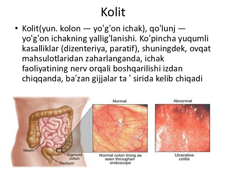 Kolit Kolit(yun. kolon — yoʻgʻon ichak), qoʻlunj — yoʻgʻon ichakning yalligʻlanishi.