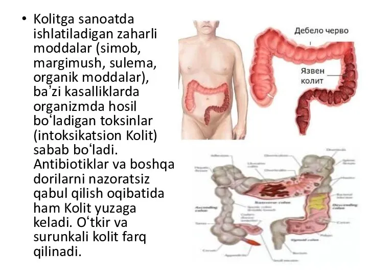 Kolitga sanoatda ishlatiladigan zaharli moddalar (simob, margimush, sulema, organik moddalar), baʼzi