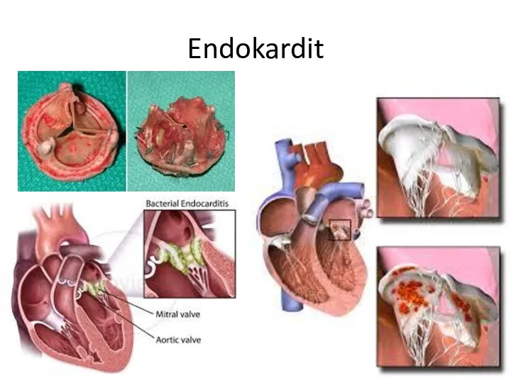 Endokardit