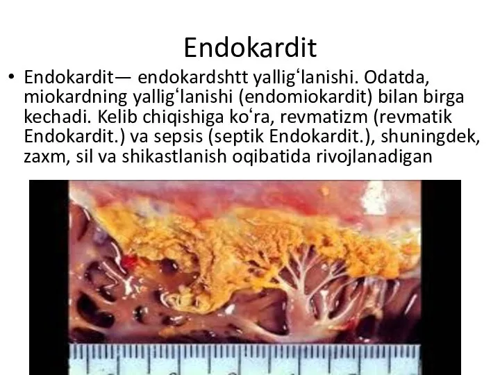 Endokardit Endokardit— endokardshtt yalligʻlanishi. Odatda, miokardning yalligʻlanishi (endomiokardit) bilan birga kechadi.