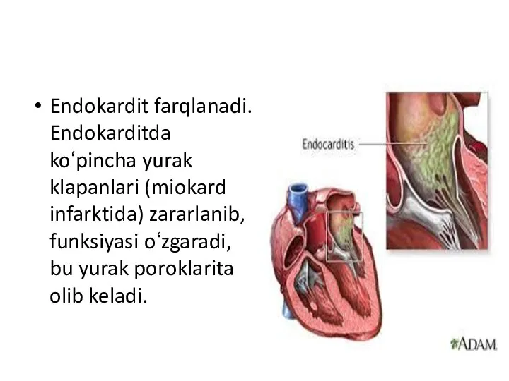 Endokardit farqlanadi. Endokarditda koʻpincha yurak klapanlari (miokard infarktida) zararlanib, funksiyasi oʻzgaradi, bu yurak poroklarita olib keladi.