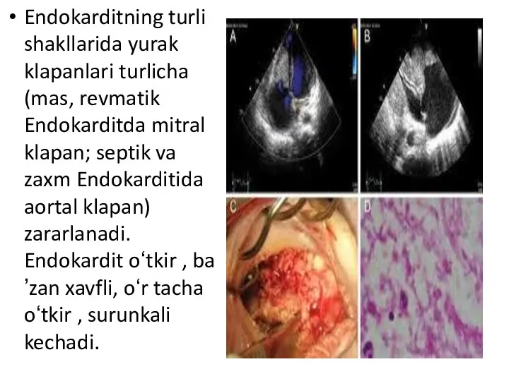 Endokarditning turli shakllarida yurak klapanlari turlicha (mas, revmatik Endokarditda mitral klapan;