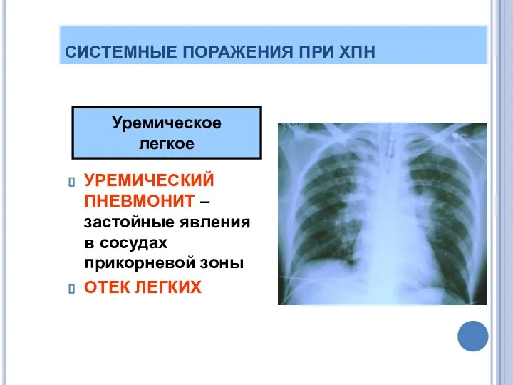 СИСТЕМНЫЕ ПОРАЖЕНИЯ ПРИ ХПН УРЕМИЧЕСКИЙ ПНЕВМОНИТ – застойные явления в сосудах