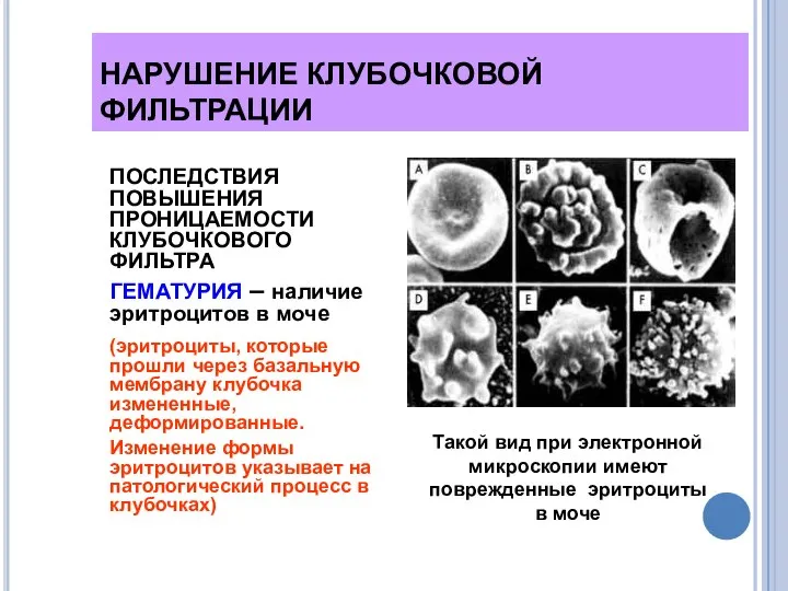 НАРУШЕНИЕ КЛУБОЧКОВОЙ ФИЛЬТРАЦИИ ПОСЛЕДСТВИЯ ПОВЫШЕНИЯ ПРОНИЦАЕМОСТИ КЛУБОЧКОВОГО ФИЛЬТРА ГЕМАТУРИЯ – наличие