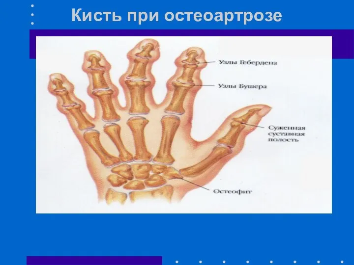 Кисть при остеоартрозе