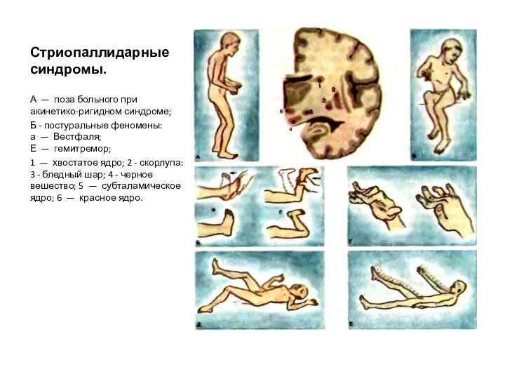 Стриопаллидарные синдромы. А — поза больного при акинетико-ригидном синдроме; Б -