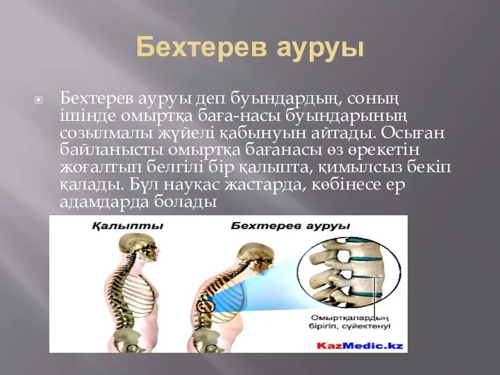 Бехтерев ауруы Бехтерев ауруы деп буындардың, соның ішінде омыртқа баға-насы буындарының