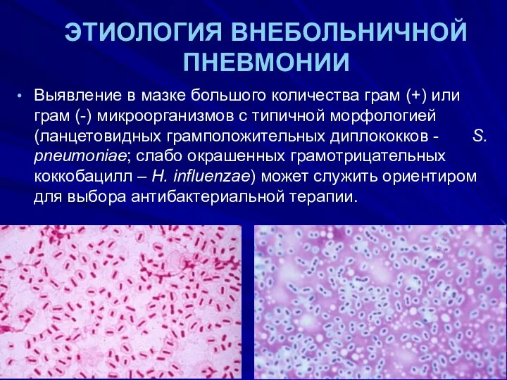 ЭТИОЛОГИЯ ВНЕБОЛЬНИЧНОЙ ПНЕВМОНИИ Выявление в мазке большого количества грам (+) или