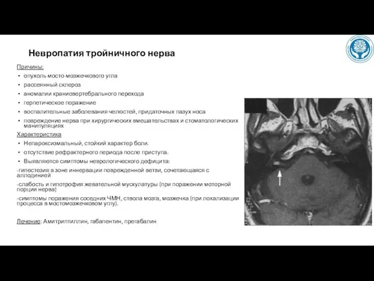 Невропатия тройничного нерва Причины: опухоль мосто-мозжечкового угла рассеянный склероз аномалии краниовертебрального