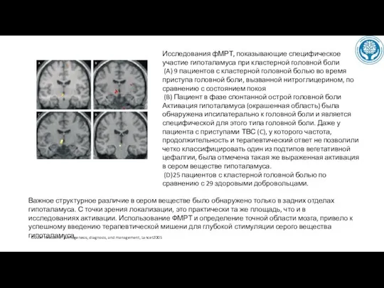 Исследования фМРТ, показывающие специфическое участие гипоталамуса при кластерной головной боли (A)