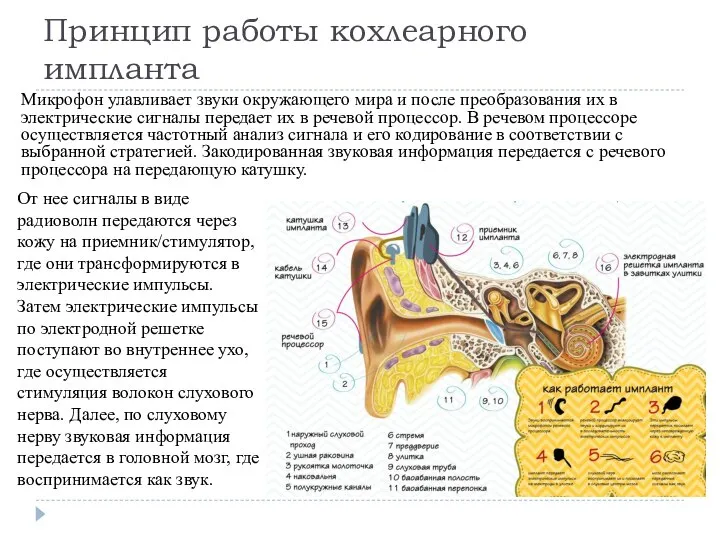 Принцип работы кохлеарного импланта Микрофон улавливает звуки окружающего мира и после