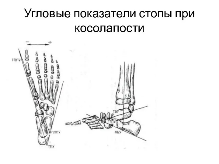 Угловые показатели стопы при косолапости