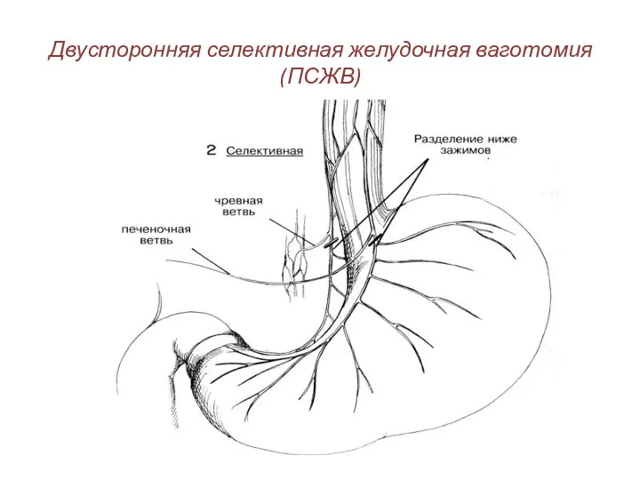 Двусторонняя селективная желудочная ваготомия (ПСЖВ)