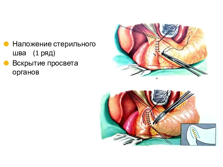 Наложение стерильного шва (1 ряд) Вскрытие просвета органов