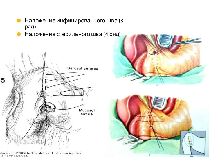 Наложение инфицированного шва (3 ряд) Наложение стерильного шва (4 ряд)