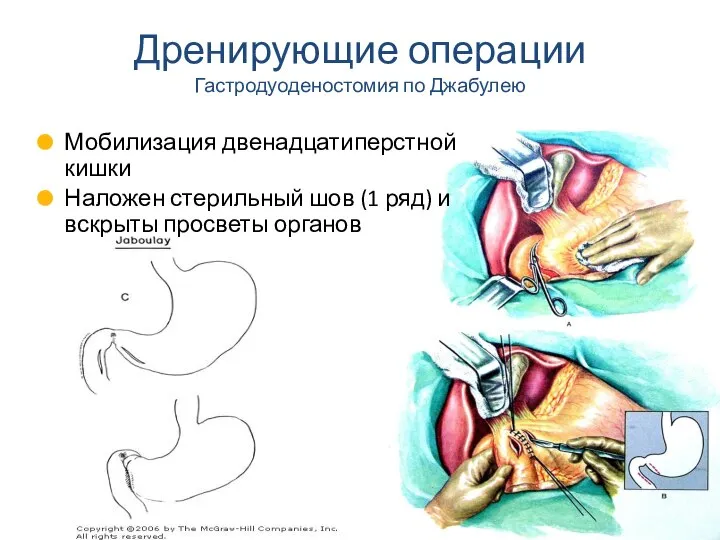 Мобилизация двенадцатиперстной кишки Наложен стерильный шов (1 ряд) и вскрыты просветы