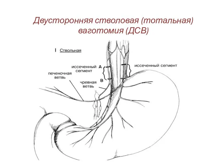 Двусторонняя стволовая (тотальная) ваготомия (ДСВ)