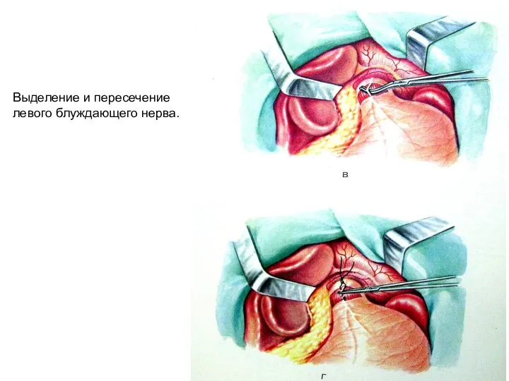 Выделение и пересечение левого блуждающего нерва.