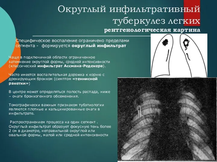 Округлый инфильтративный туберкулез легких рентгенологическая картина Чаще в подключичной области ограниченное