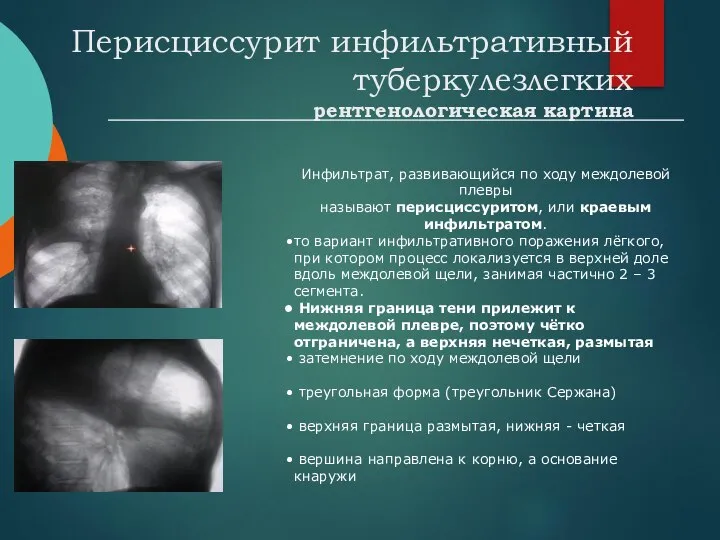 Перисциссурит инфильтративный туберкулезлегких рентгенологическая картина Инфильтрат, развивающийся по ходу междолевой плевры