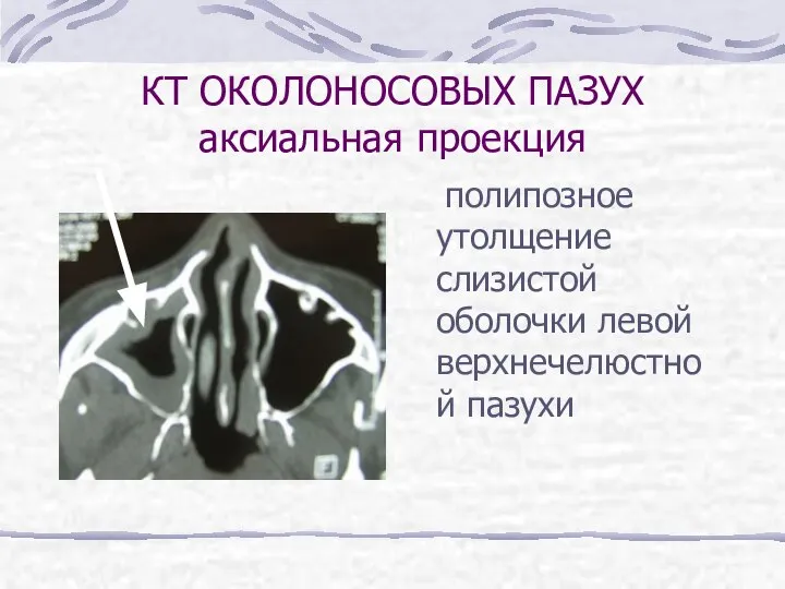 КТ ОКОЛОНОСОВЫХ ПАЗУХ аксиальная проекция полипозное утолщение слизистой оболочки левой верхнечелюстной пазухи