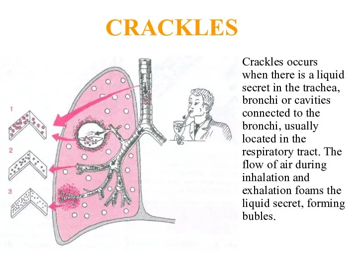 CRACKLES Crackles occurs when there is a liquid secret in the