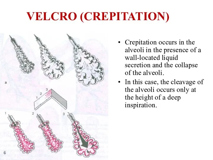 VELCRO (CREPITATION) Crepitation occurs in the alveoli in the presence of