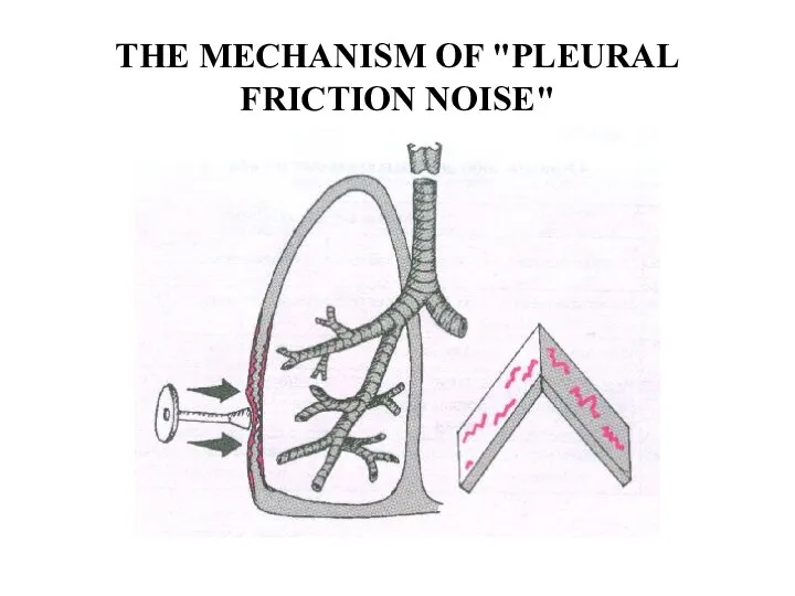 THE MECHANISM OF "PLEURAL FRICTION NOISE"