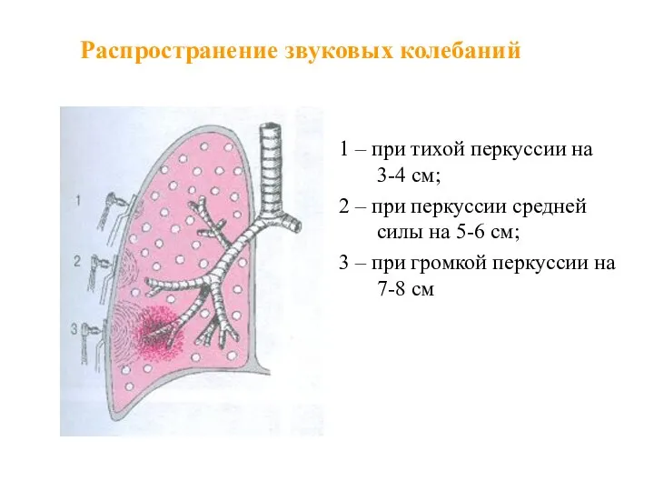 Распространение звуковых колебаний 1 – при тихой перкуссии на 3-4 см;