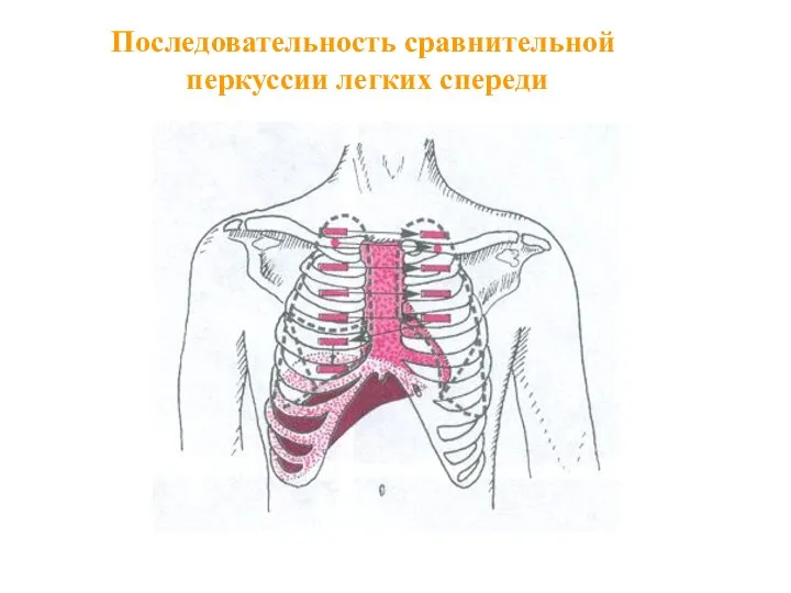 Последовательность сравнительной перкуссии легких спереди